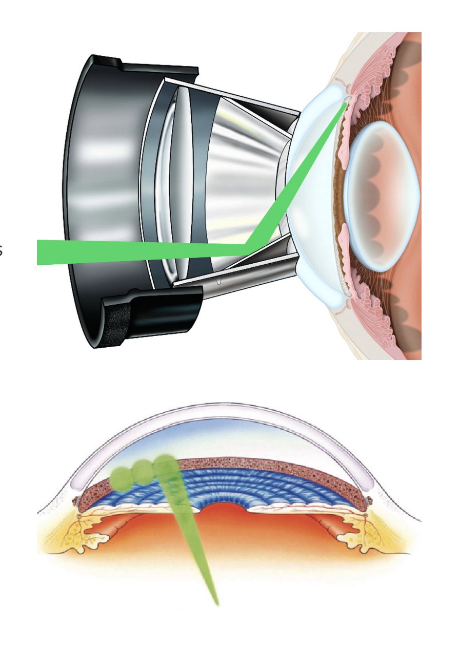 SLT Laser for Glaucoma