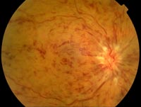 img-Central-Retinal-Vein-Occlusion